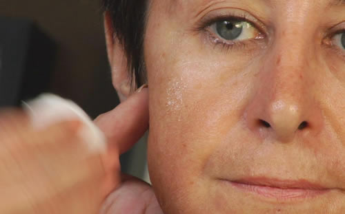 Eliminar las marcas de acné